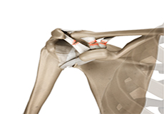 AC or Acromioclavicular Separation/Dislocation/Reconstruction
