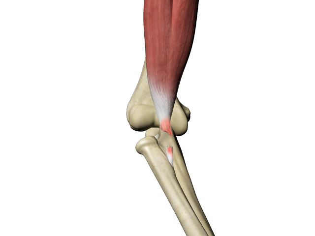 Biceps Tendon Rupture