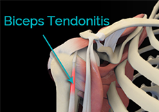 Biceps Tendonitis 