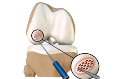 Knee Microfracture
