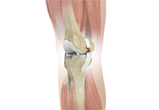 Ligament Tears