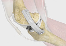 MCL Reconstruction