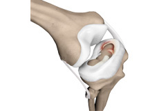 Meniscus Repair Surgery