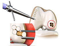 Osteochondral Autograft Transfer System (OATS)