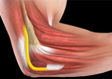 Elbow (Olecranon) Bursitis