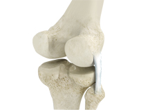 Posterolateral Corner Injuries