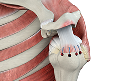 Rotator Cuff Repair