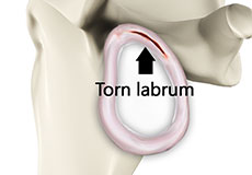 Shoulder Labrum Tear