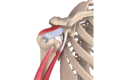 Superior Capsule Reconstruction