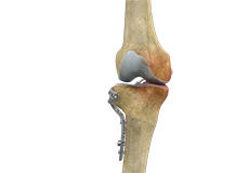 Tibial Tubercle Osteotomy